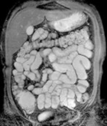 MRT (Magnetresonanztomographie), Strahlentherapie | Strahlenexposition | Praxis für Radiologie & Nuklearmedizin